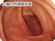 大腸の内視鏡写真